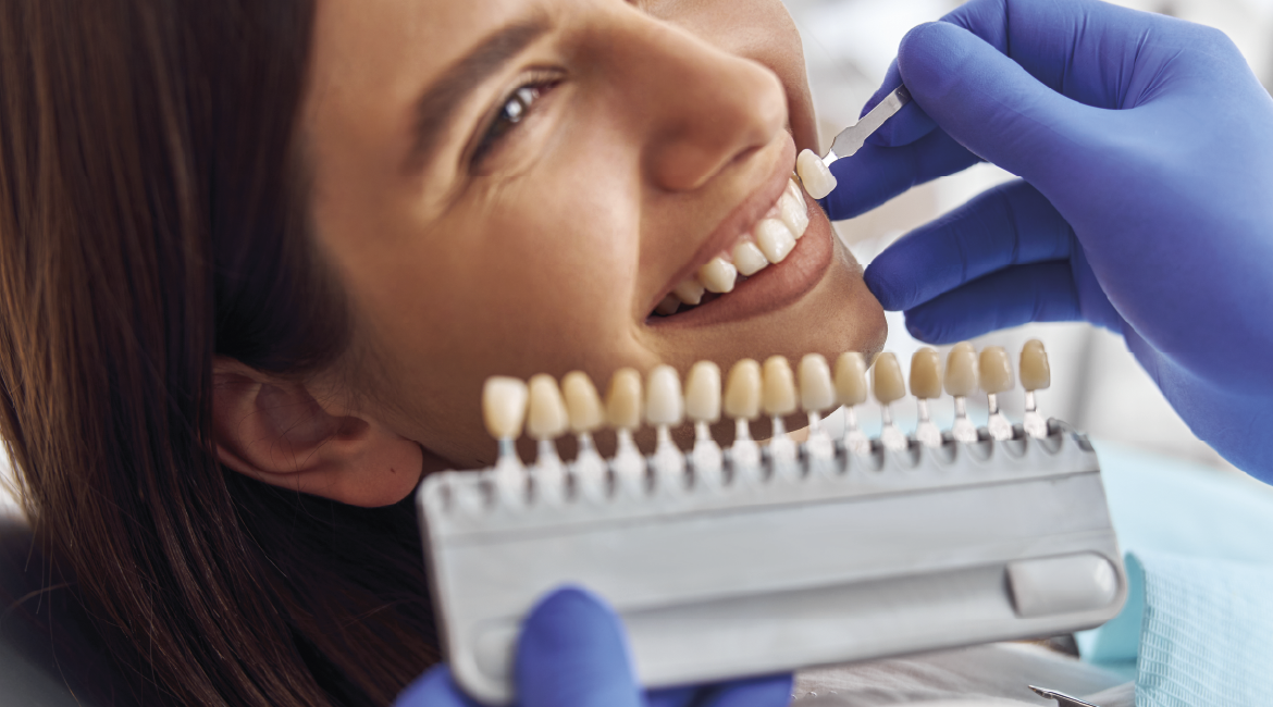 Carillas Dentales: Beneficios y Dudas Frecuentes