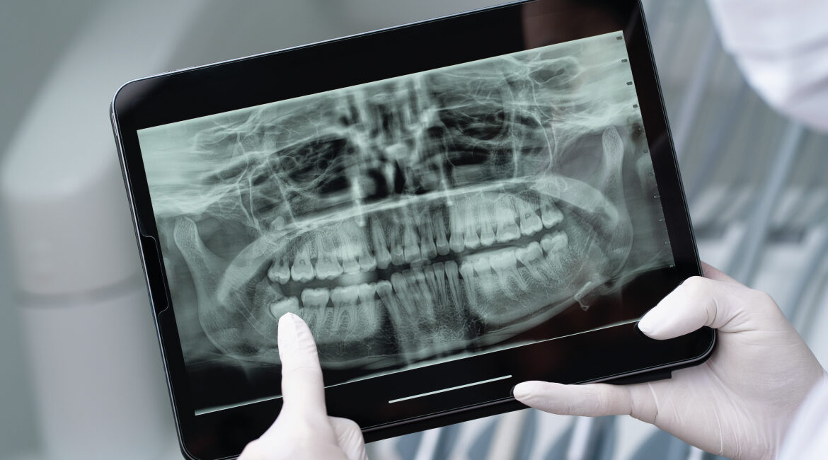 Radiografías dentales: cuándo son necesarias y qué detectan