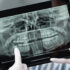 Radiografías dentales: cuándo son necesarias y qué detectan