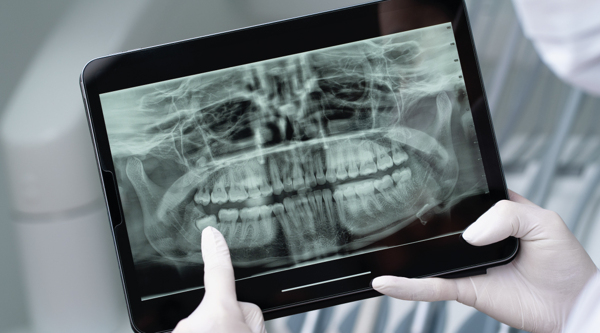 Radiografías dentales: cuándo son necesarias y qué detectan
