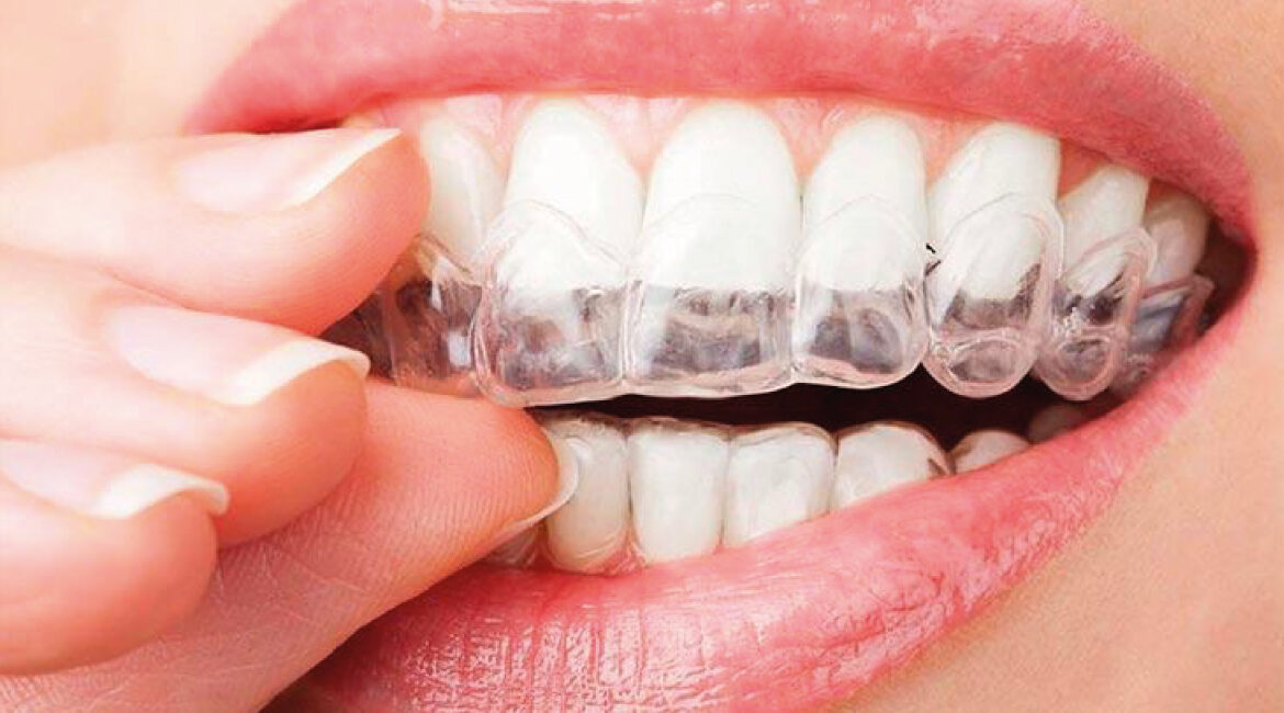 ¿Es buen momento para empezar una ortodoncia invisible en verano?